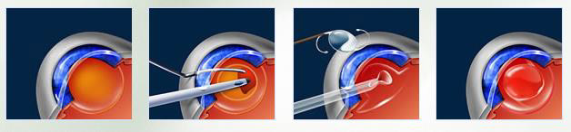 Stages of Cataract Surgery