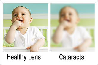 Healthy Lens Vs Cataract Lens